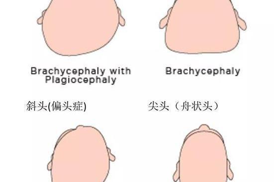 关于三个月宝宝偏头的探讨